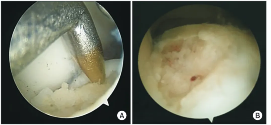 Figure 3. (A) Arthroscopic photographs  showing that microfractures were performed  of the osteochondral lesion of the talus