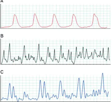 Fig. 2. Changes in 8-OHdG and SOD. Values are expressed as means±standard deviations. 8OHdG: 8-hydroxy-2-deoxyguanosine, SOD: superoxide  dismutase, DO: detrusor overactivity