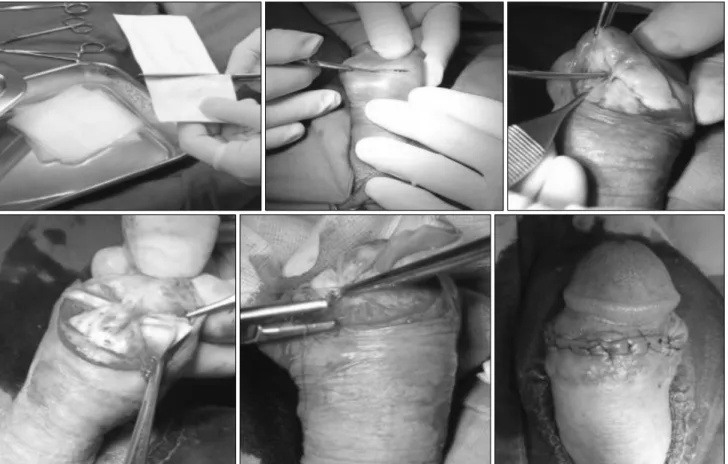 Fig. 8. Preparation and procedures for indirect glans penis augmentation by Lyoplant (B