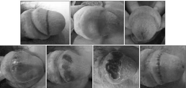 Fig. 6. Serial changes of pressure necrosis after overinjection of BellaGen (modified SureDerm; Hans Biomed Co., Seoul, Korea).