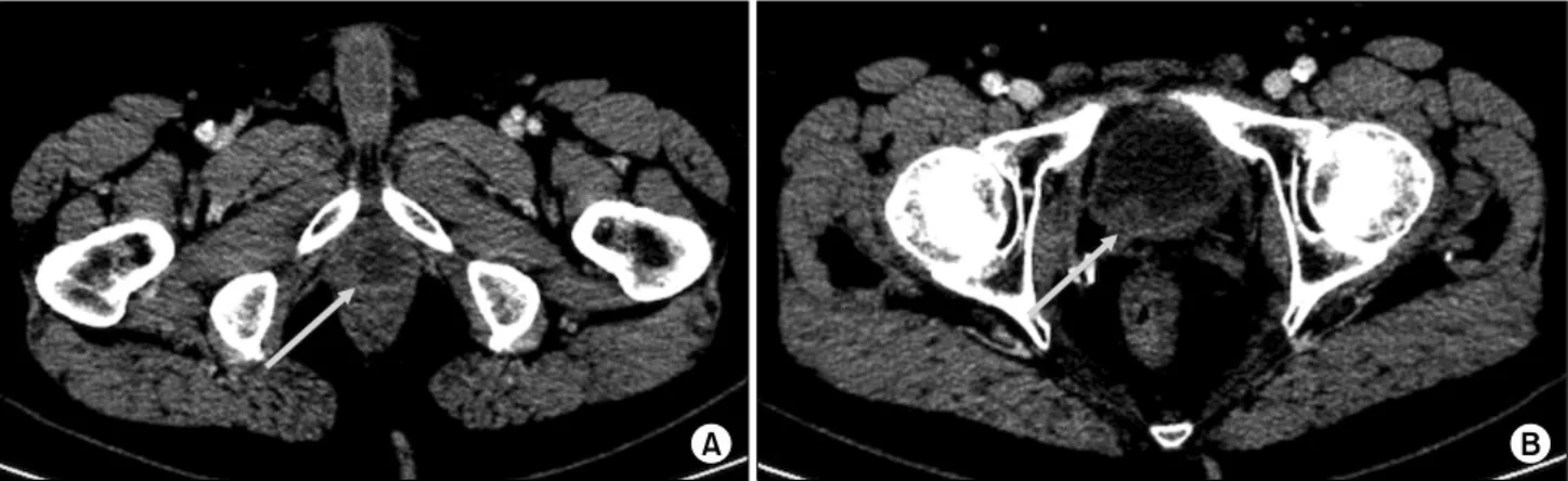Fig. 1. Computed tomography (CT) images show two lesions suspected for seminal vesicle recurrence