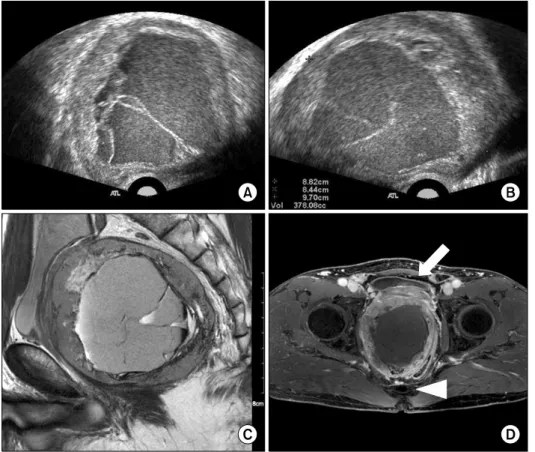 Fig. 1. (A, B) Transrectal ultra- ultra-sonography revealed that the huge  prostatic mass measuring 97×88×