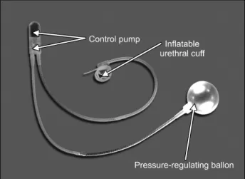 Fig. 1. Artificial urinary sphincter components. Picture provided by AMS company.