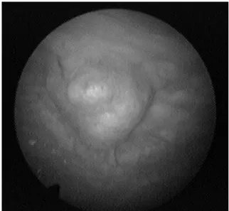 Fig. 1. Cystoscopy results revealed a smooth sessile mass at the bladder dome.