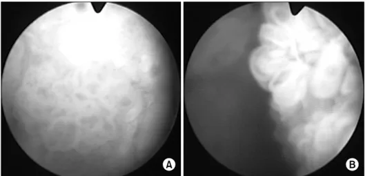 Fig. 2. Cystoscopic findings of a  papillary mass in the trigone (A)  and left lateral wall of the bladder  (B).