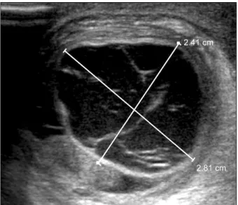 Fig. 2. The hernia sac filled with hemorrhagic fluid (white arrow) was separated from right testis