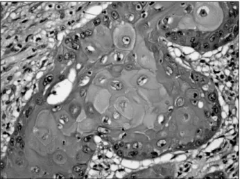 Fig. 3. Moderate-differentiated squamous cell carcinoma. Nests of infiltrating squamous cells with hyperchromatic nuclei and  prominent keratin production should be noted (H&amp;E, ×400).