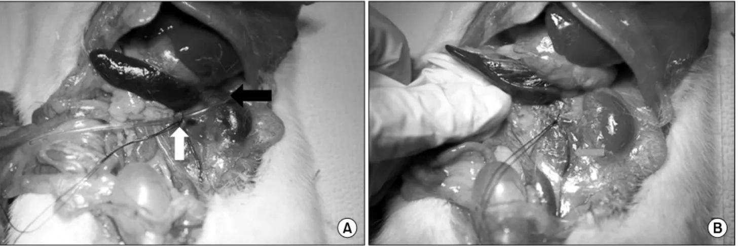 Fig.  1.  (A)  It  shows  ligation  of  proximal  renal  vein  with  plastic  probe.  Black  arrow  indicates  plastic  probe  and  white  arrow  indicates  the  engorgement  of  left  gonadal  vein  and  distal  renal  vein