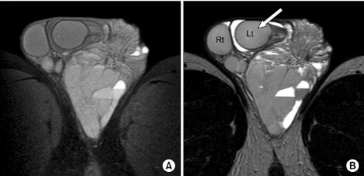 Fig.  2.  Ultrasonography  shows  ill-defined  multiloculated  cystic  lesion  with  various  echogenecity  in  scrotum