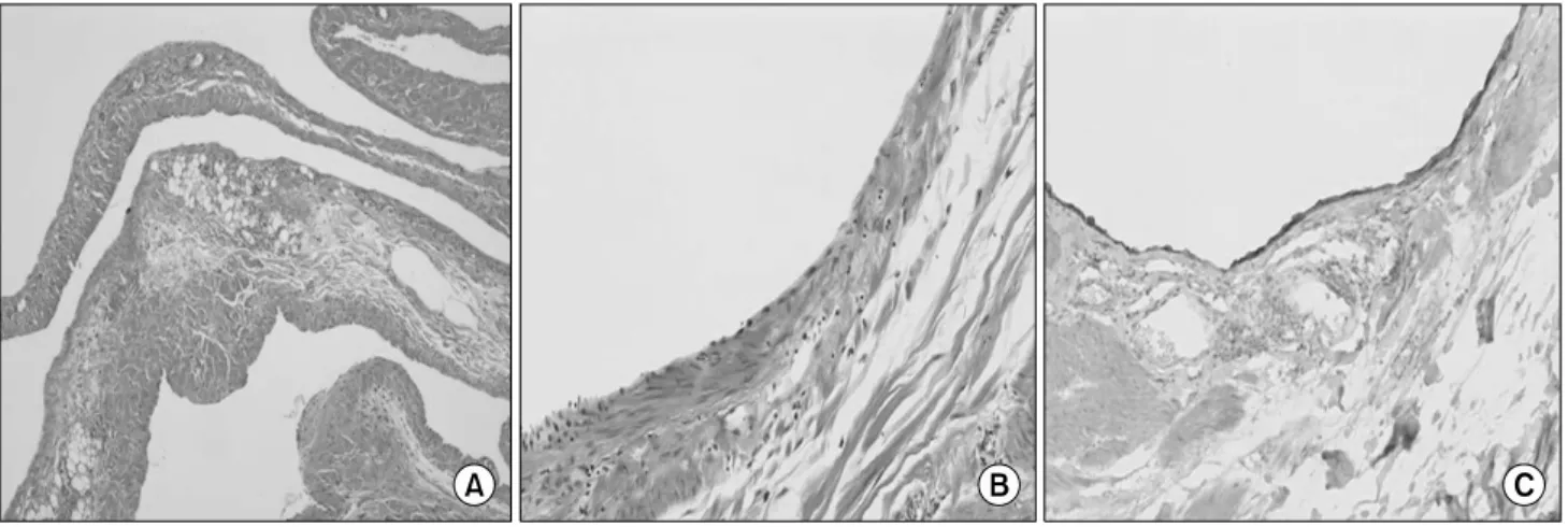 Fig.  4.  Histologic  findings  of  tumor.  (A)  Tumor  is  composed  of  cystically  dilated  spaces  (H&amp;E  ×40)