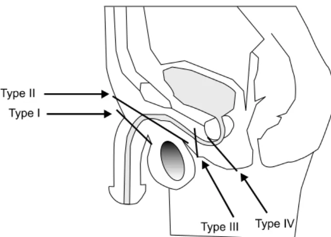 Fig.  1.  Schematic  representation  of  classification. 3   Type  I  injury:  the  most  proximal  part  of  corpora  are  intact  and  urinary  meatus  is  on  surface  of  palpable  corporal  stump,  Type  II  injury: 