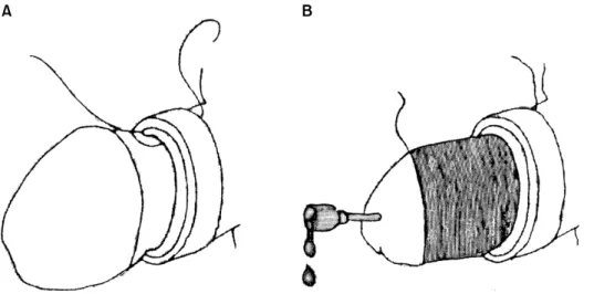 Fig.  2.  Schematic  drawing  of  the  modified  string  method. 9   (A)  Ligature  of  silk  string  is  passed  proximally  through  bearing