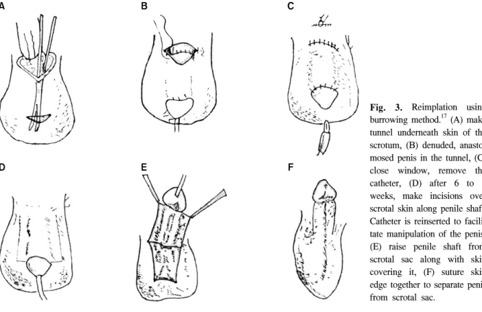 Fig.  3.  Reimplation  using  burrowing  method. 17   (A)  make  tunnel  underneath  skin  of  the  scrotum,  (B)  denuded,   anasto-mosed  penis  in  the  tunnel,  (C)  close  window,  remove  the  catheter,  (D)  after  6  to  8  weeks,  make  incisions 