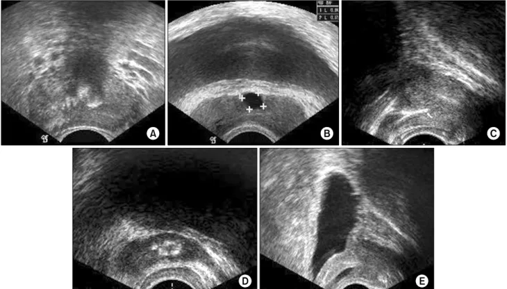 Table  2.  Abnormal  findings  in  transrectal  ultrasonography Abnormal  findings No