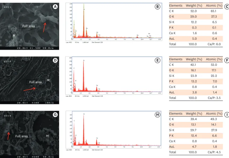 Figure 3. Scanning electron microscopy observations and elemental composition obtained using energy-dispersive X-ray analysis of the surface precipitates  produced by (A-C) MM-MTA, (D-F) BD, and (G-I) ESRRM putty at 4 weeks after the subcutaneous implantat