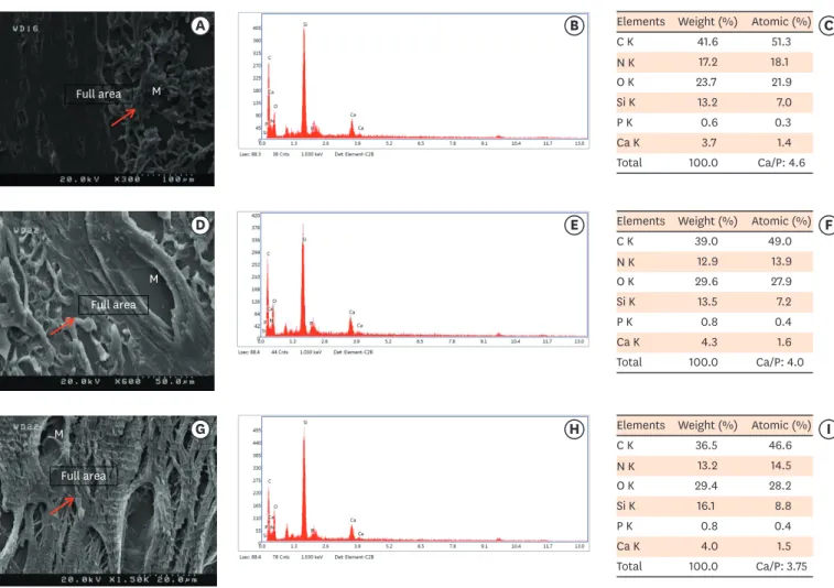 Figure 4. Scanning electron microscopy observations and elemental composition obtained using energy-dispersive X-ray analysis of the surface precipitates  produced by (A-C) MM-MTA, (D-F) BD, and (G-I) EndoSequence Root Repair Material putty at 8 weeks afte