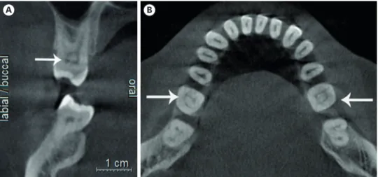 Figure 1. Teeth with pulp stones on different sections of cone-beam computed tomography (CBCT)