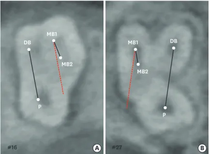 Figure 1. Measurement of the angle between the line connecting the MB1-MB2 and that connecting the DB-P  canals in a maxillary molar