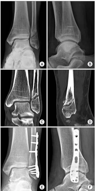 Figure 1. A 68-year-old male with lateral malleolar fracture (Denis- (Denis-Weber type B, Lauge-Hansen supiration-external rotation type) visited  our clinic after conservative treatment