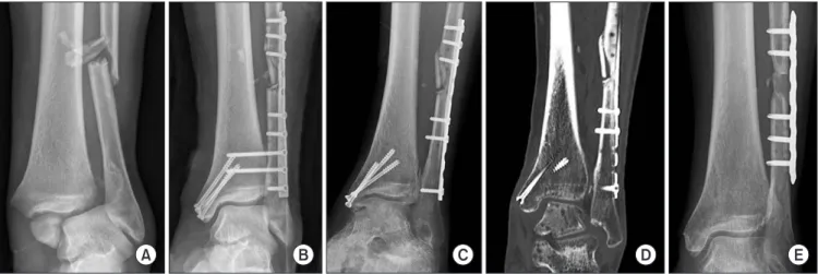 Figure 2. A 40-year-old male presents for evaluation of continued ankle pain 8 months after open reduction and internal fixation of a bimalleolar  fracture