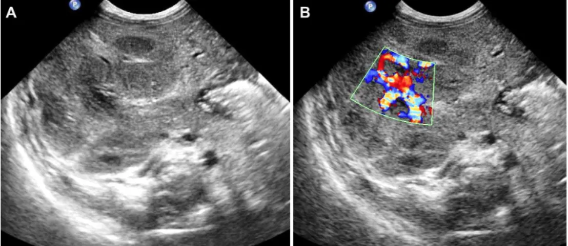 Fig. 2. (A) Liver sonogram presenting multiple hypoechoic lesions within the liver parenchyme