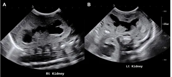 Fig. 1. Both kidneys appear to be diffusely increased (measuring about 4.3 cm) in its parenchymal  echogenicity with dilatation of both renal pelvocalyces