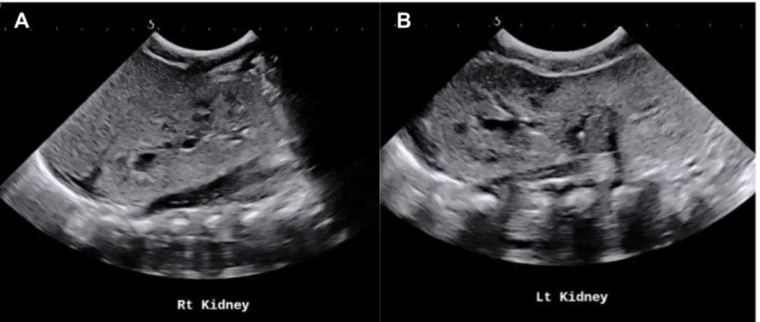Fig. 4. Longitudinal section of the right (A) and left (B) kidney showing complete resolution of hydrone- hydrone-phrosis and the fungal ball