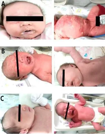 Fig. 2. Three types of Staphylococcal scalded skin syndrome (SSSS). 