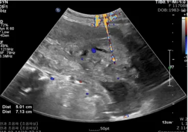 Fig. 2. Ultrasonographic image showing 7.13×5.01 cm sized mixed  echogenic area in the anterior wall of uterus at postpartum
