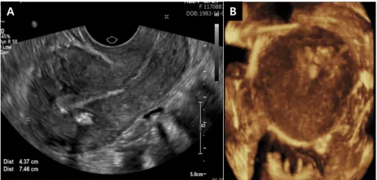 Fig. 4. (A) Two-dimensional (2D) ultrasonography after the return of menstruation. (B) Three- Three-dimensional (3D) ultrasonography after the return of menstruation.