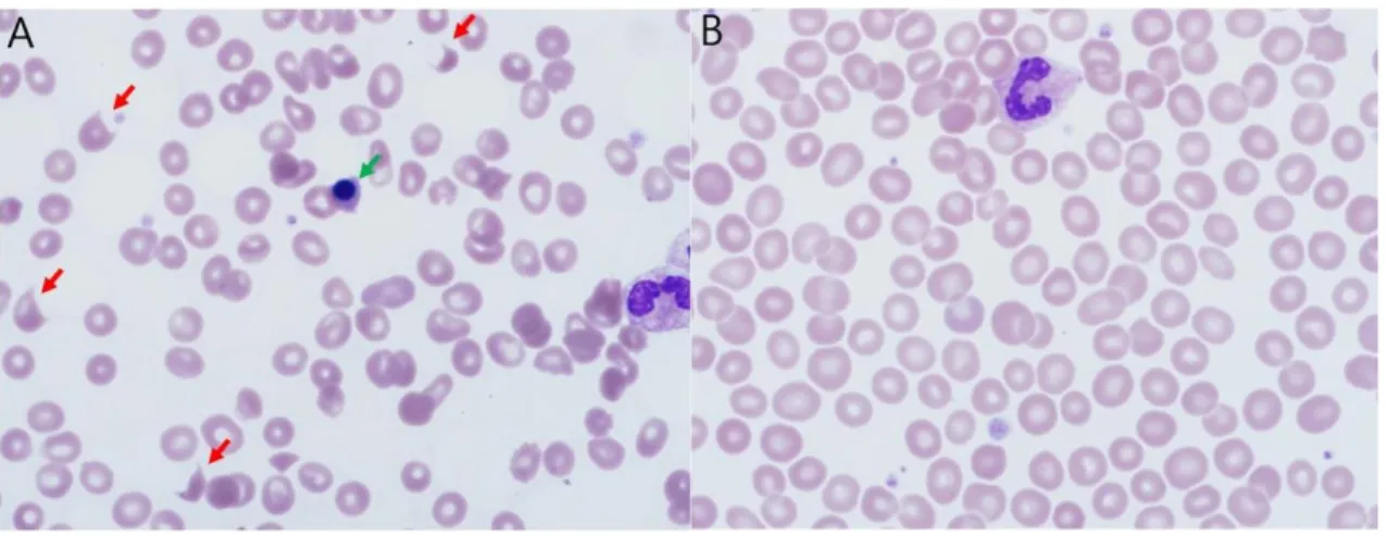 Fig. 1. Peripheral blood smears (A: before, B: after) showing many schistocytes (red arrows) and a nucleated red blood cell  (green arrow) (×1,000, Wright stain).