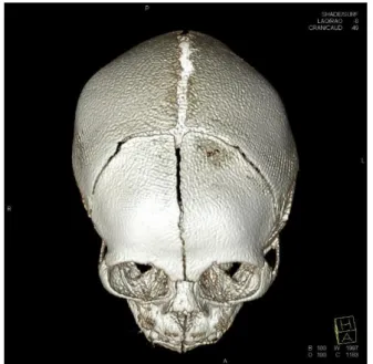 Fig. 2. Computed tomography 3-dimension facial bone revealed  relatively narrowing of both coronal sutures with overlapping of both  frontal and parietal bones.