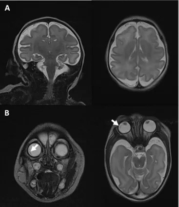 Fig. 3. Magnetic resonance brain of a microcephaly with congenital  retinal detachment