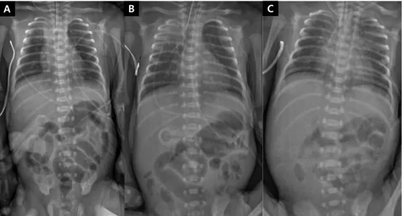Fig. 2. Abdominal ultrasonography showing target sign at the ileum  area. The arrow points to small bowel intussusception.