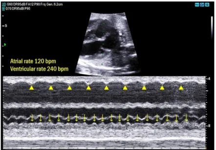 Fig. 2. M-mode echocardiographic image at 29.2 weeks of gestation showing the  indicator line crossing the right atrium and left ventricle (upper column)