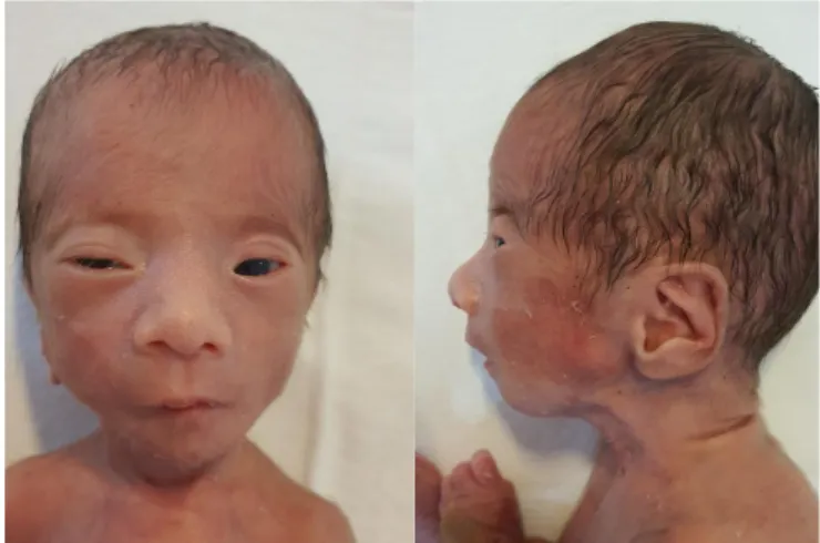 Fig. 1. Clinical photo of our patient. Typical dysmorphic face, short and  upwardly slanting palpebral fissure, low set ears, a bulbous nose, and  micrognathia.