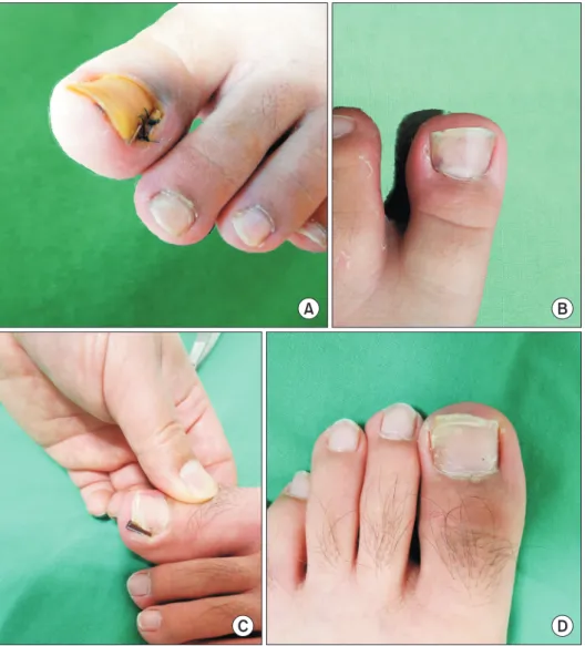 Figure 2. (A) Ingrown nail treated with  gutter splint fixed by suture. (B) After  healing there was a small puncture that  may play as a stress riser and be easily  broken