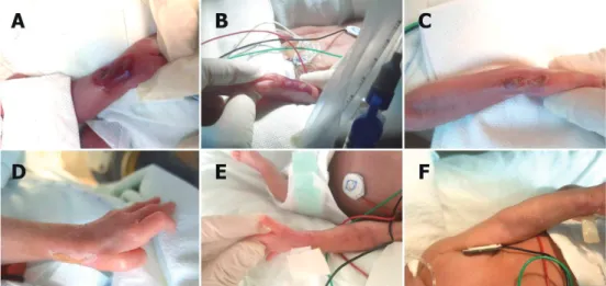 Fig. 1. (A) Full-thickness skin necrosis of the left forearm and wrist due to extravasation of bicarbonate on  the first day of hospitalization