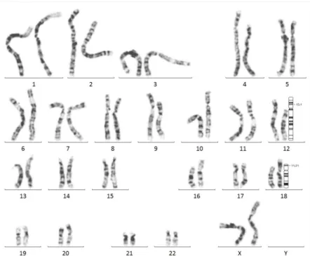 Fig. 3. Partial trisomy 12p [der(18)t(12;18)(p11.2;p11.31)] diagnosed by chromosomal  study.