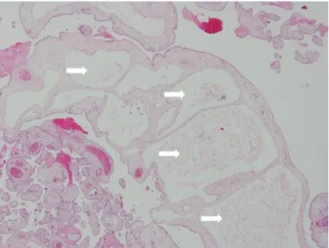 Fig. 1. Transabdominal ultrasonography scan at 24+3 weeks’ gestation  shows a thickened placenta (6.4 cm) with multiple hypoechoic cysts,  which suggests a possibility of partial hydatidiform mole.