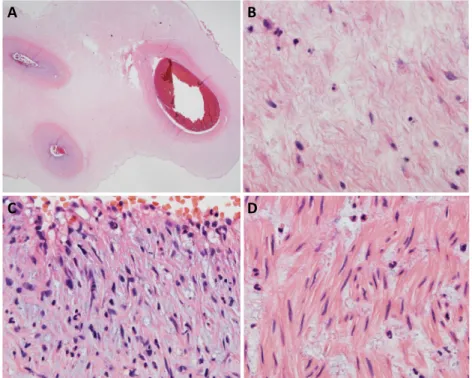Fig. 2. Pathology of acute chorioamnionitis and funisitis of placenta (A: H&amp;E, ×200; B-D: 