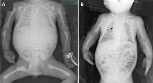 Fig. 4. (A) The infantogram shows acute respiratory distress syndrome (ARDS). (B) Improved ARDS since  first study and rule out linear atelectasis (arrow) at in right low lung field.