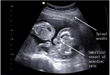 Fig. 1. Reverse flow in the umbilical artery of the acardiac twin. UA,  umbilical artery