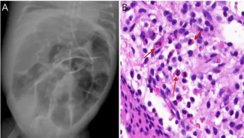 Fig. 1. Abdominal radiography showing marked bowel dilatation on the 45th day of life (33  weeks and 4 days of postmenstrual age) (A)