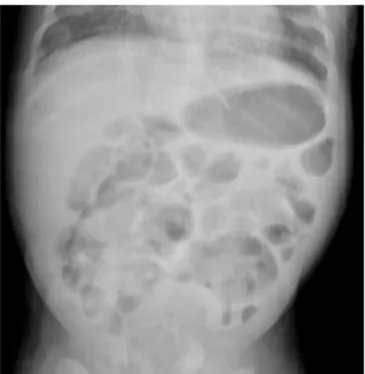 Fig. 3. Improvements of the diffuse bowel dilatation and pneumatosis  are observed after modification of the diet to an amino acid-based  formula.