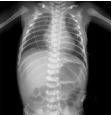 Fig. 2. Plain abdominal X-ray shows non-specific stomach and bowel  pattern at first day of hospitalization.