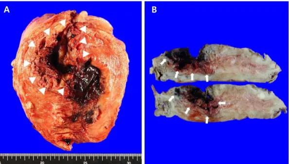 Fig. 3. Gross findings of the uterus. (A) (Coronal section, mid-portion) The white arrowheads indicate the second  uterine cavity created by the myometrial dehiscence