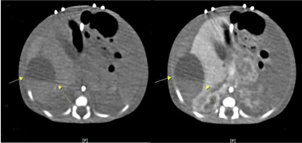 Fig. 3. Pre- and post-contrast abdominal computed tomography images in case 2 show a hypo- hypo-dense lesion, localized in the subcapsular zone of the liver, with fluid-fluid level (arrow) and large  volume of ascites, suggesting hemorrhage.