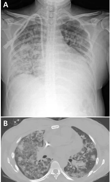Fig. 1. (A) Chest radiograph showing diffuse consolidation. (B) Chest  computed tomography scan showing diffuse ground glass opacity  and nodular consolidation.