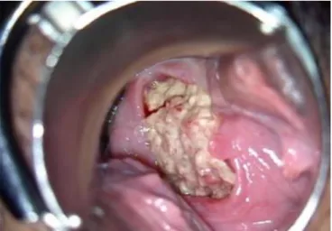 Fig. 1. Deep vaginal ulcerative lesion. Deep vaginal ulcer was observ- observ-ed right above 11 o’clock of the uterine cervix.